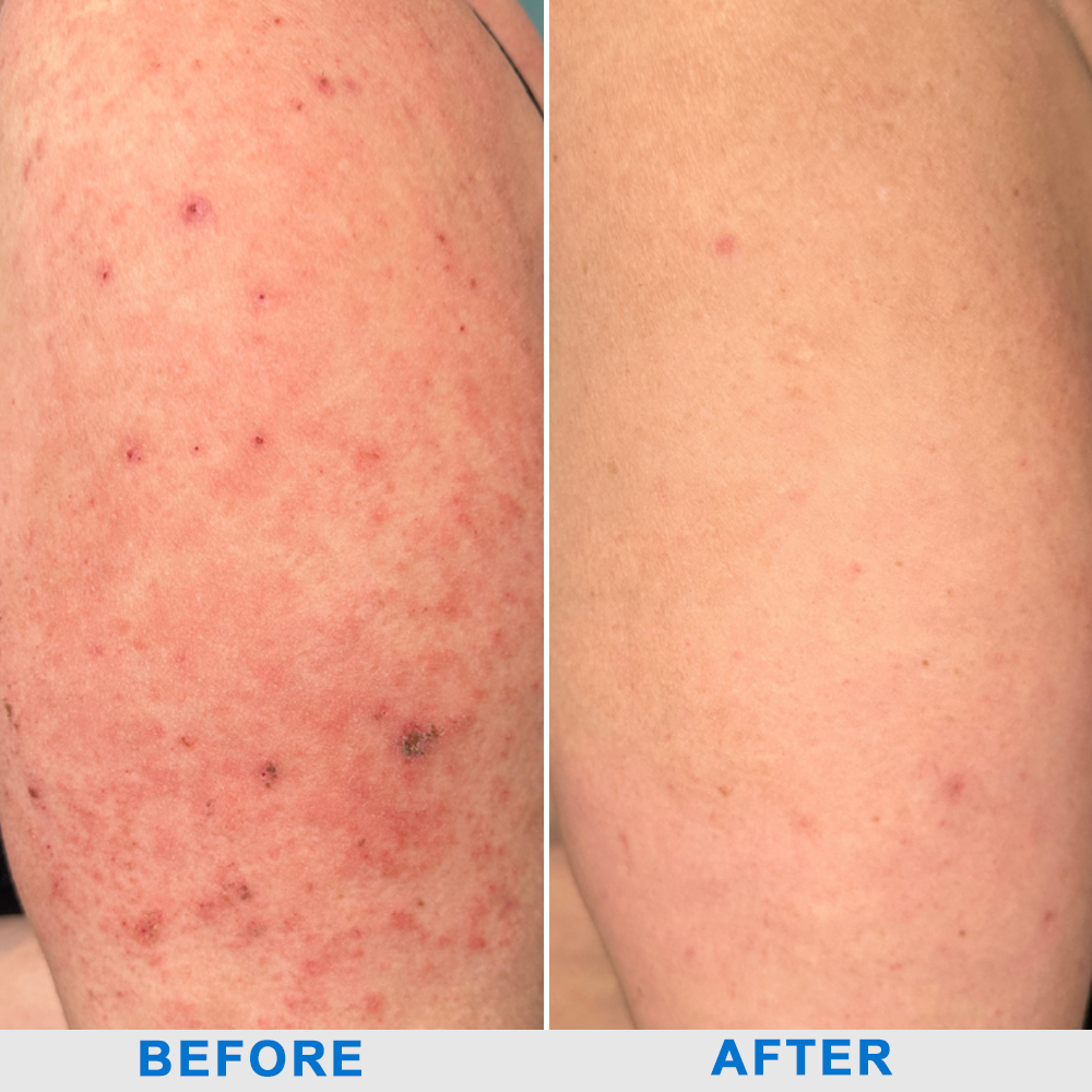 ATTDX® C+ Skin Dermatitis Cream