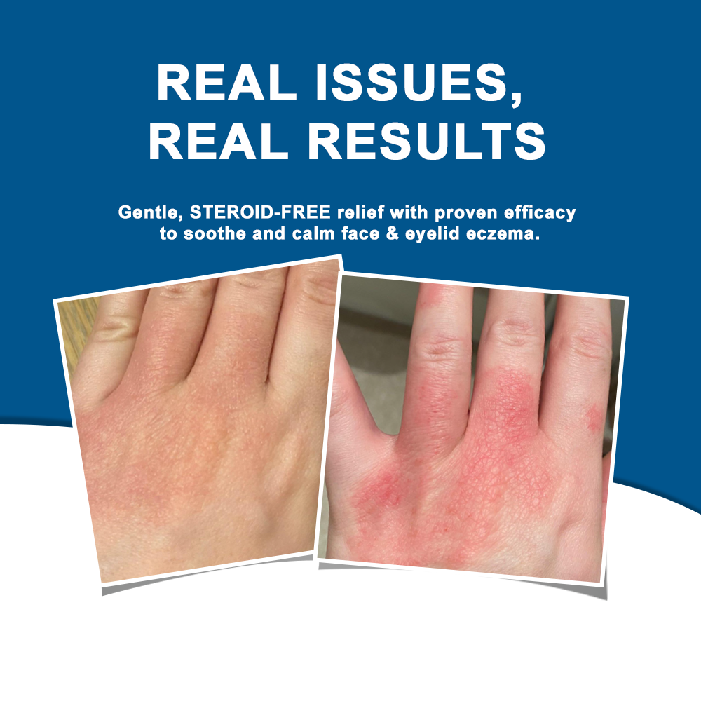 ATTDX® C+ Skin Dermatitis Cream