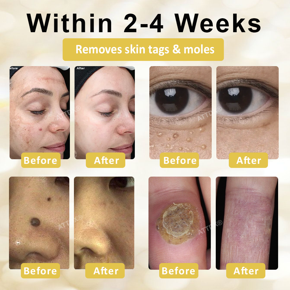 ATTDX® ApisCare Blemish & Tag Remover Stick