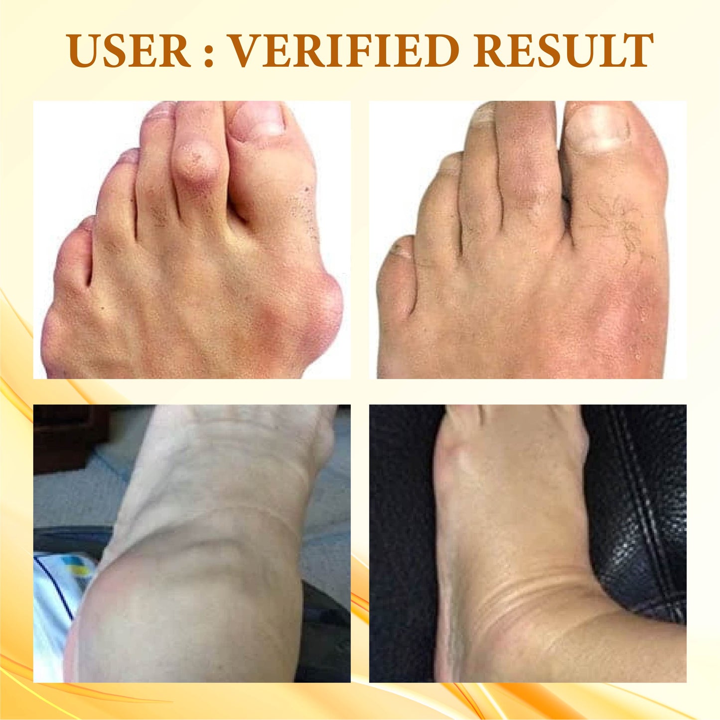 ATTDX™ Bee Venom UricEase JointRelief Cream