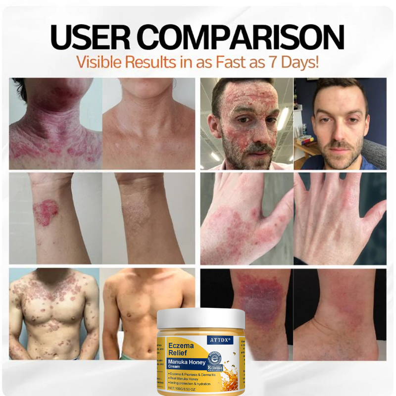 ATTDX® Eczema Relief Manuka Honey Cream