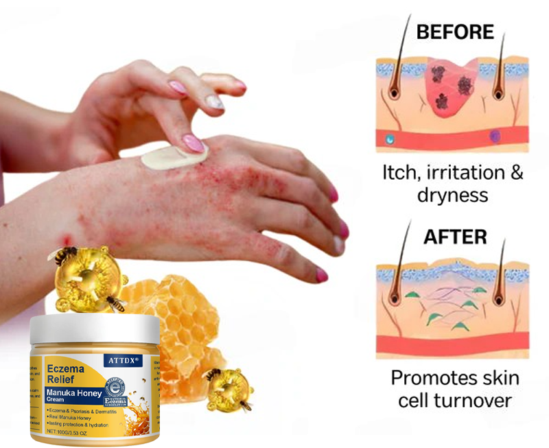ATTDX® Eczema Relief Manuka Honey Cream