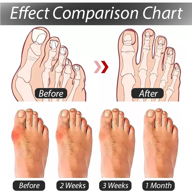 ArthroCareX™ BunionEase Corrector Sock