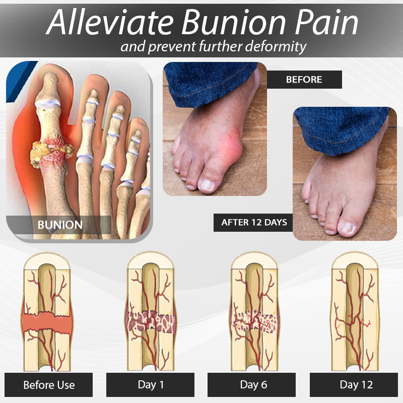 ArthroCareX™ BunionEase Corrector Sock