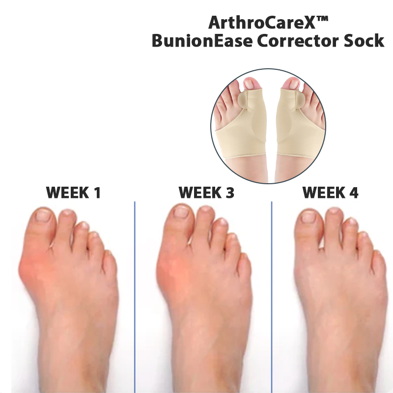 ArthroCareX™ BunionEase Corrector Sock