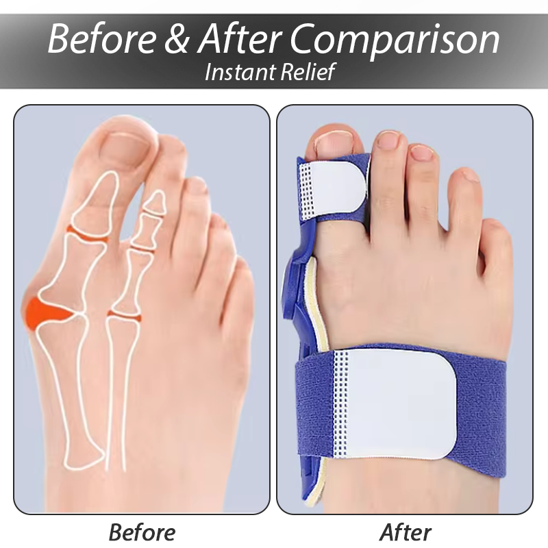 ArthroCareX™ Hallux Bunion Corrector