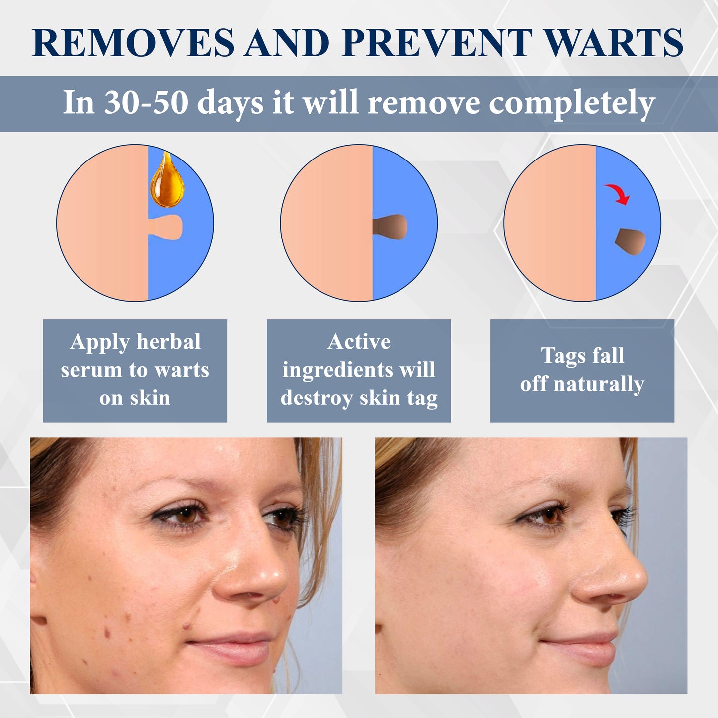 ATTDX® WartsOff Fast-Acting Herbal Cream