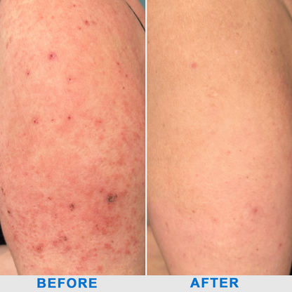 ATTDX® C+ Skin Dermatitis Cream