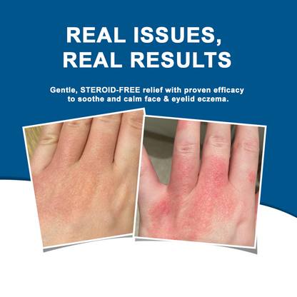 ATTDX® C+ Skin Dermatitis Cream