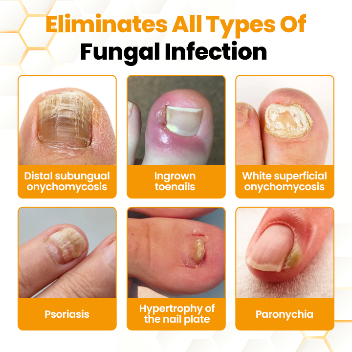 ApisHeal™ BeeVenom Anti-Fungal Nail Renewal Oil