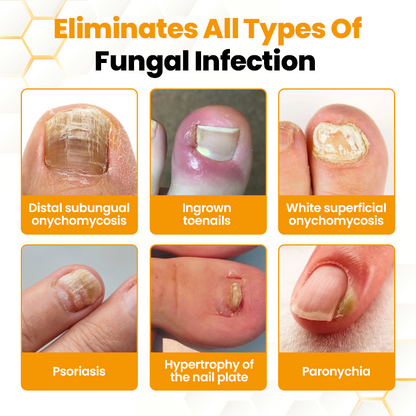 ApisHeal™ BeeVenom Anti-Fungal Nail Renewal Oil