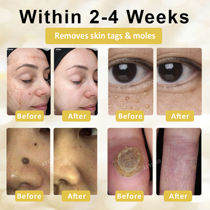 ATTDX® ApisCare Blemish & Tag Remover Stick
