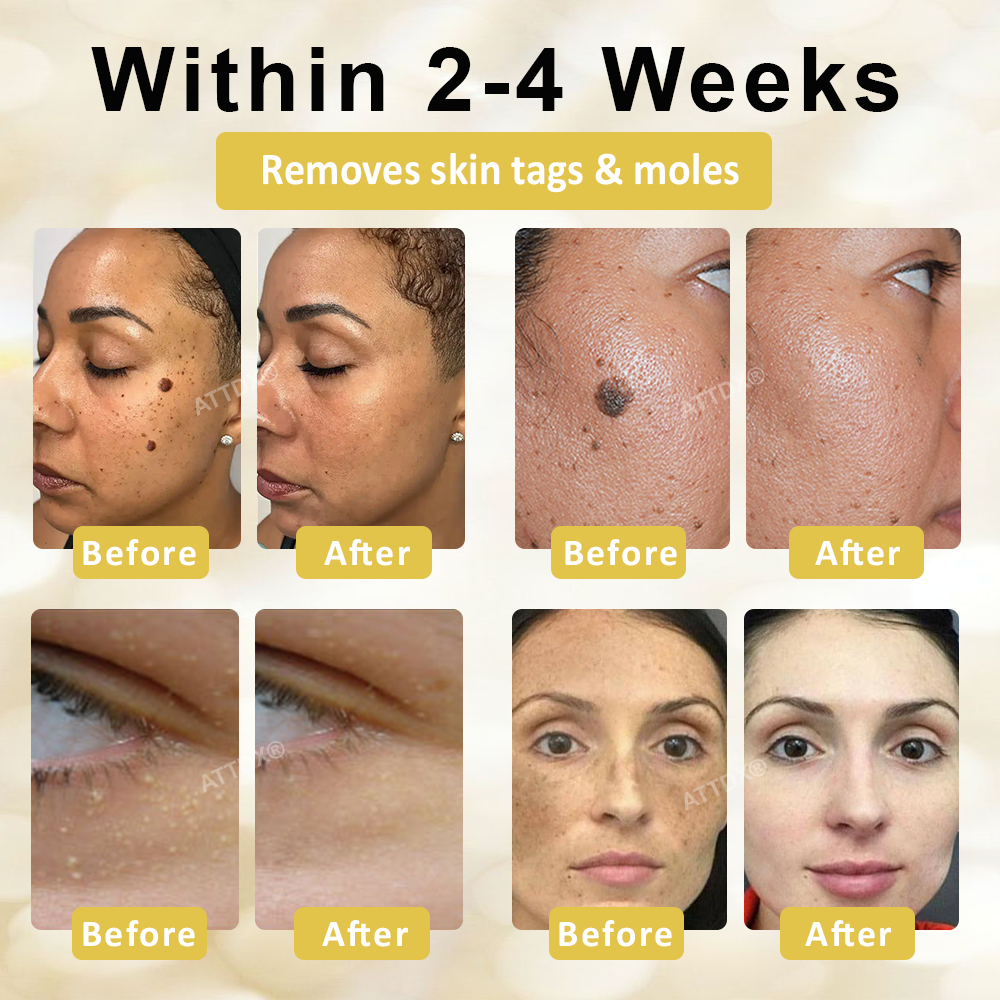 ATTDX® ApisCare Blemish & Tag Remover Stick