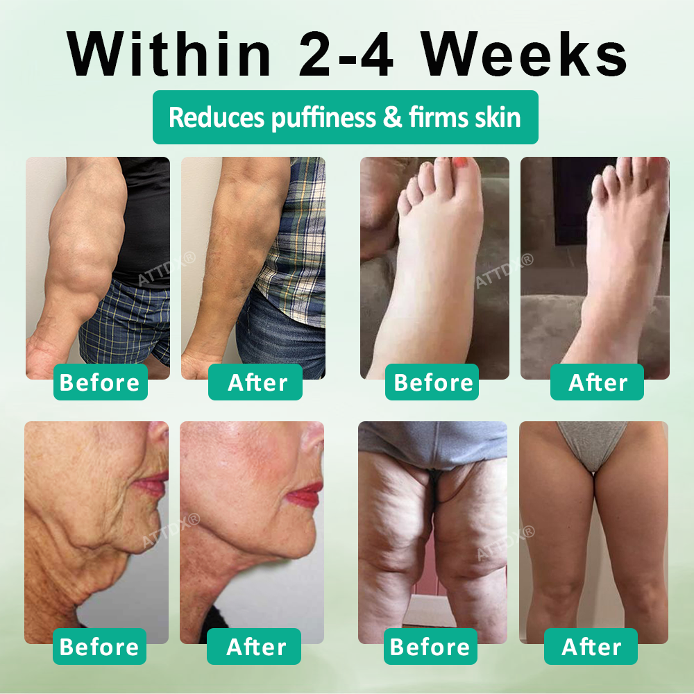 ATTDX® ApisSlim Tansy Oil Anti-Swelling Roller