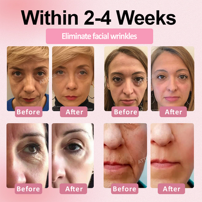 ATTDX® Botox-Tech Serum Infused Micro Dart Patch