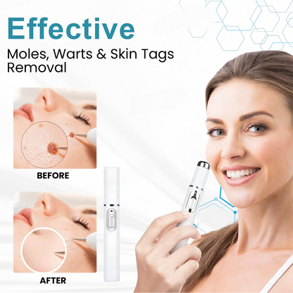 RICPIND® Non-Invasive Mole and Wart Removal Laser Pen