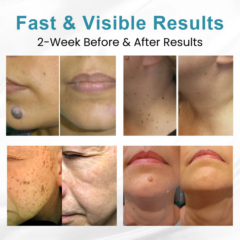 RICPIND® Non-Invasive Mole and Wart Removal Laser Pen