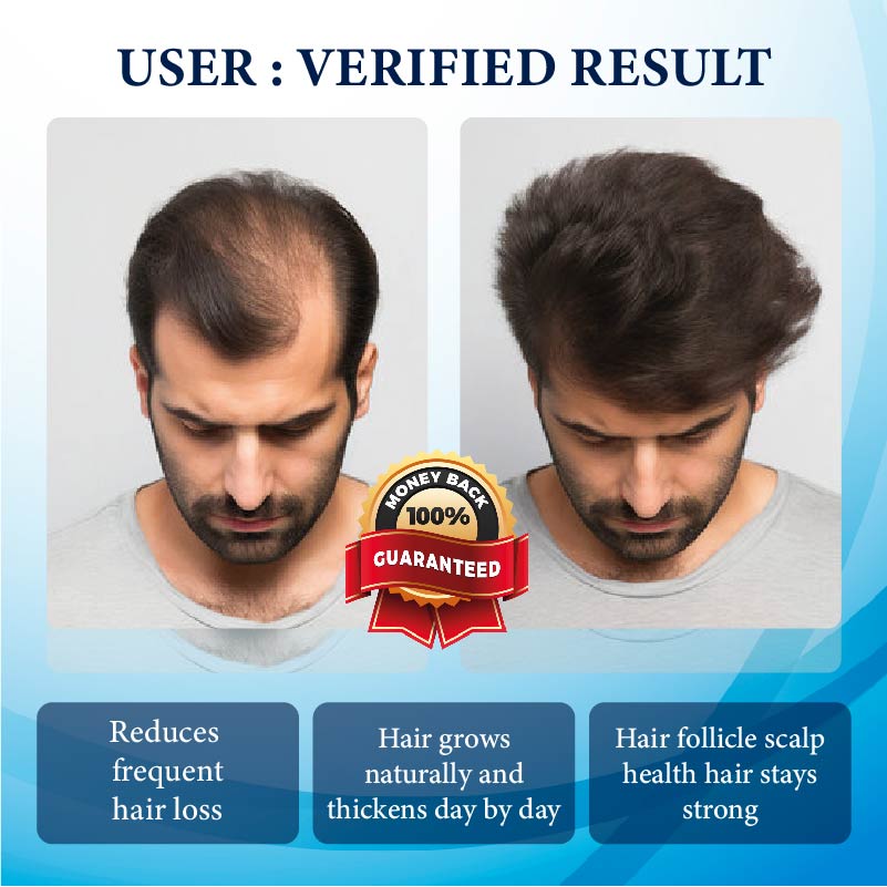 FolliFusion™ ThickBoost Herbal HairGrowth Serum for Men