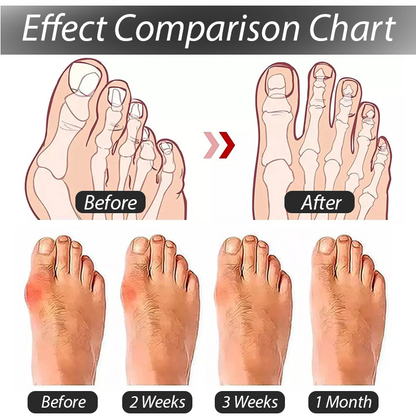 ArthroCareX™ BunionEase Corrector Sock