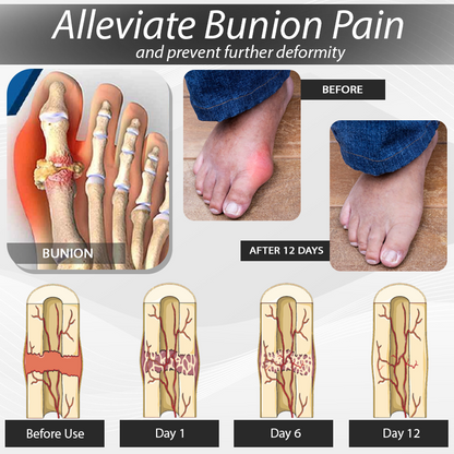 ArthroCareX™ BunionEase Corrector Sock