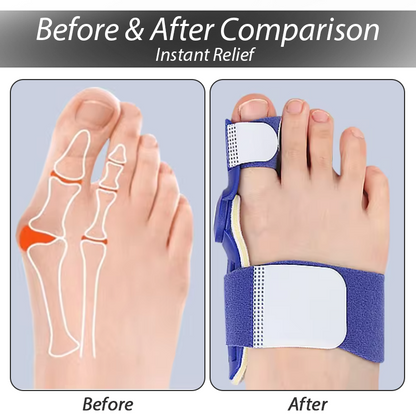 ArthroCareX™ Hallux Bunion Corrector