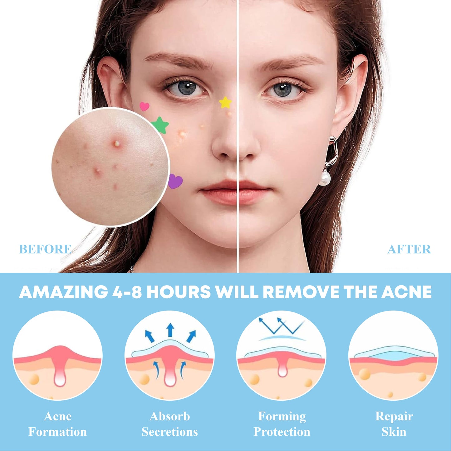 [Official Store] DermaEase™ Acne Skin Tag Removal Star Patches