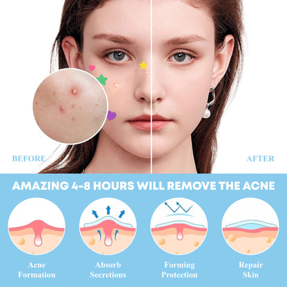[Official Store] DermaEase™ Acne Skin Tag Removal Star Patches