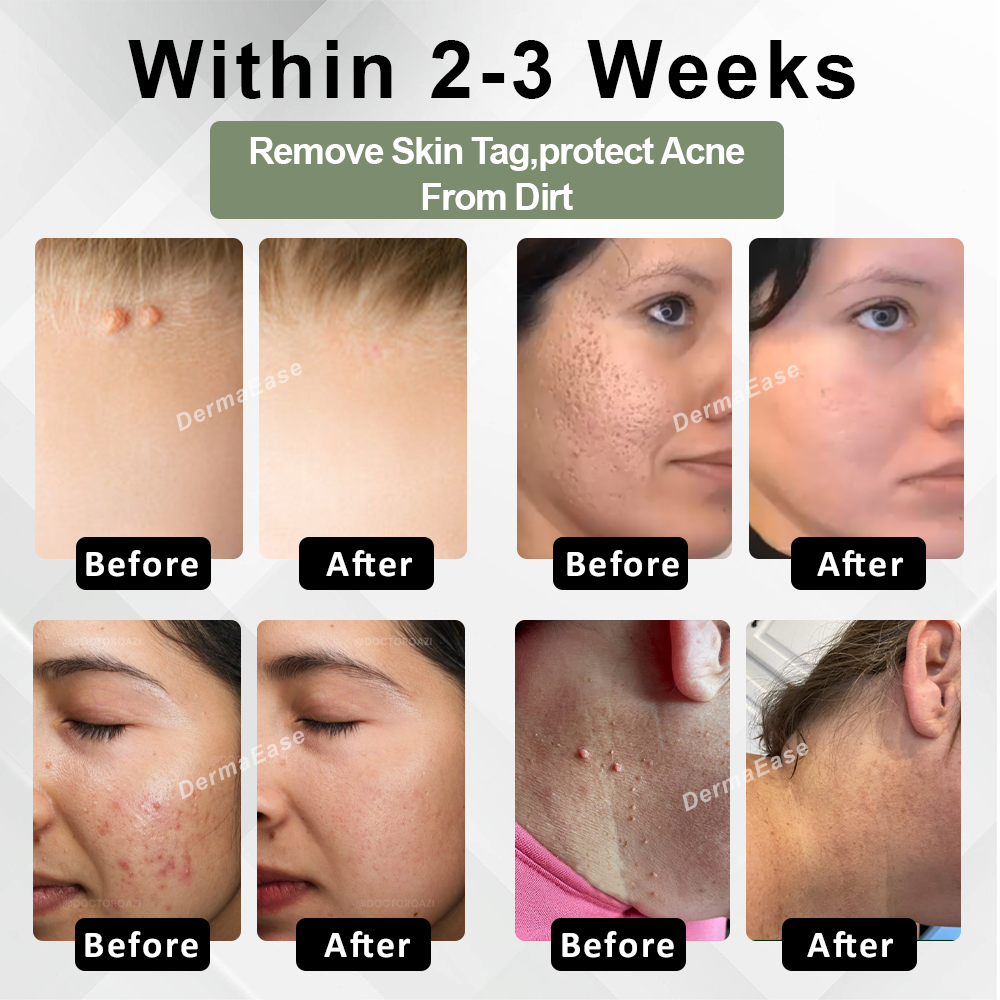 [Official Store] DermaEase™ Acne Skin Tag Removal Star Patches