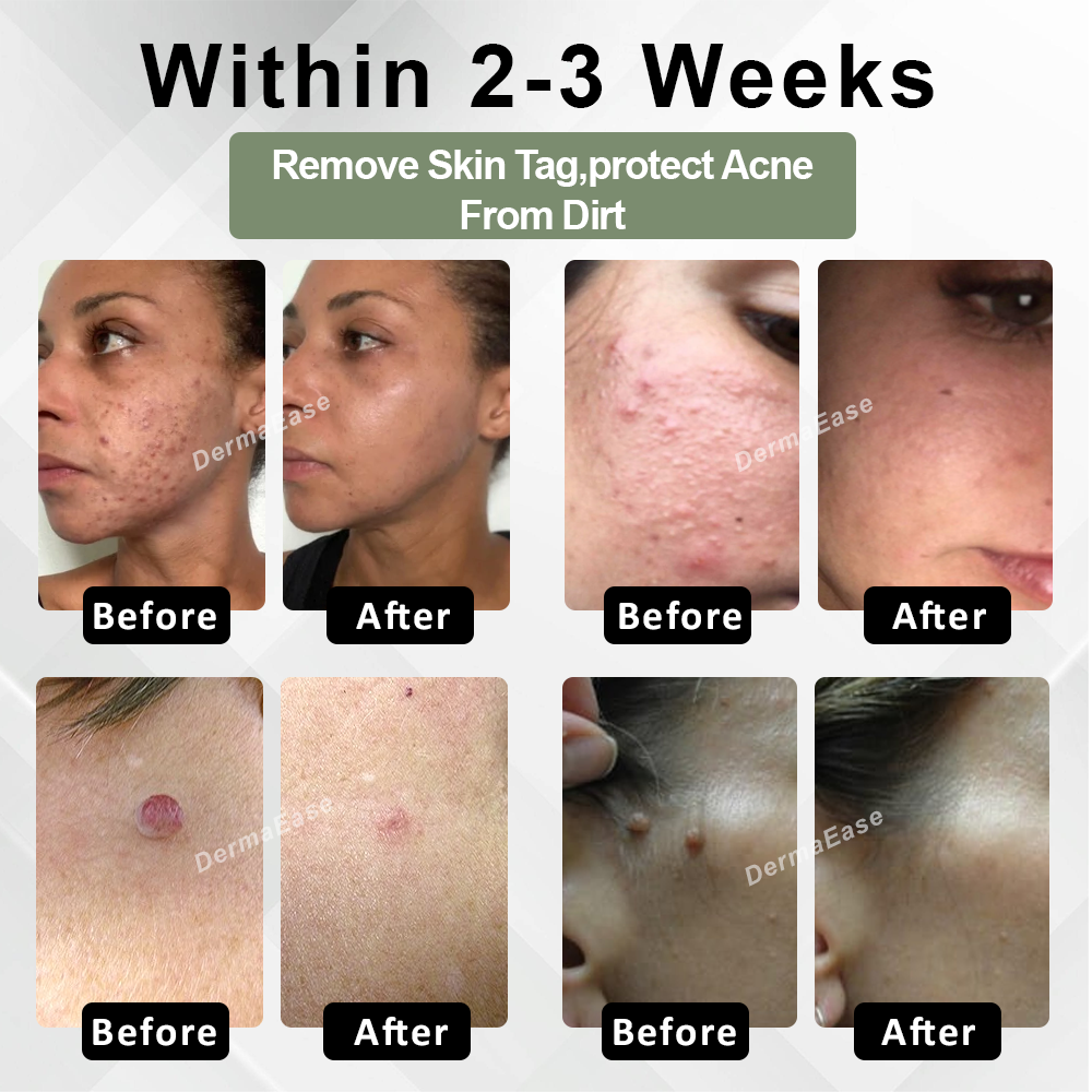 [Official Store] DermaEase™ Acne Skin Tag Removal Star Patches