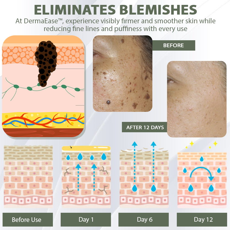 [Official Store] DermaEase™ Acne Skin Tag Removal Star Patches