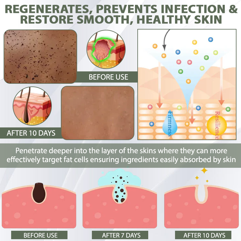 [Official Store] DermaEase™ Acne Skin Tag Removal Star Patches