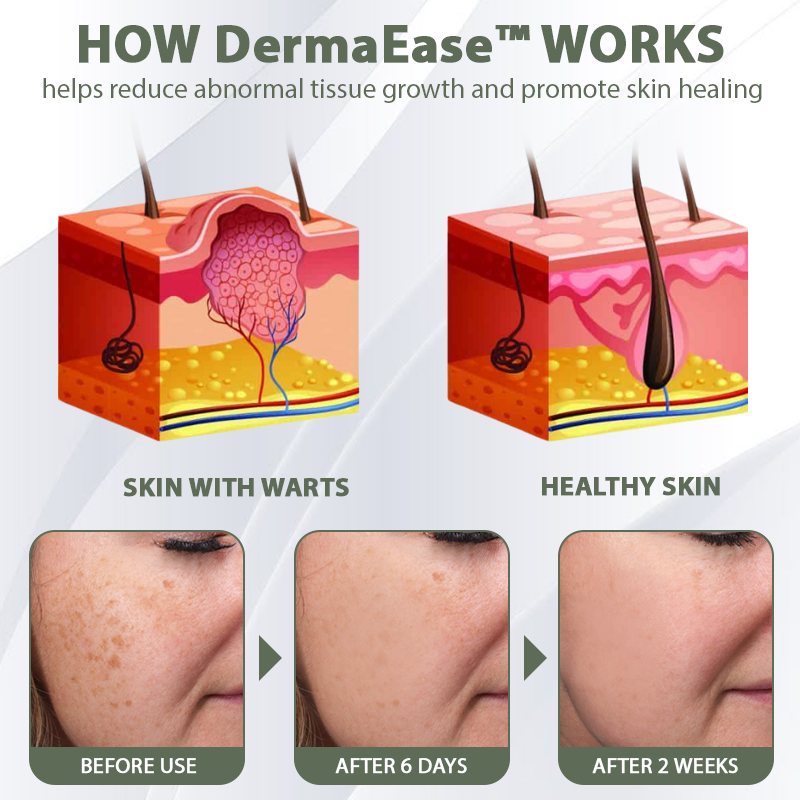 [Official Store] DermaEase™ Acne Skin Tag Removal Star Patches