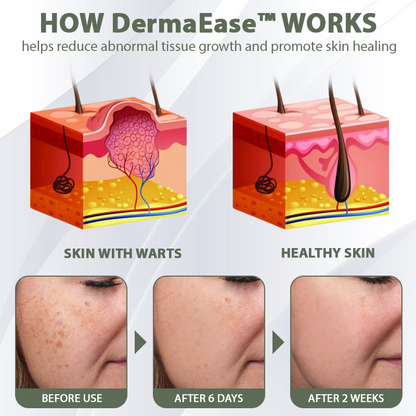 [Official Store] DermaEase™ Acne Skin Tag Removal Star Patches