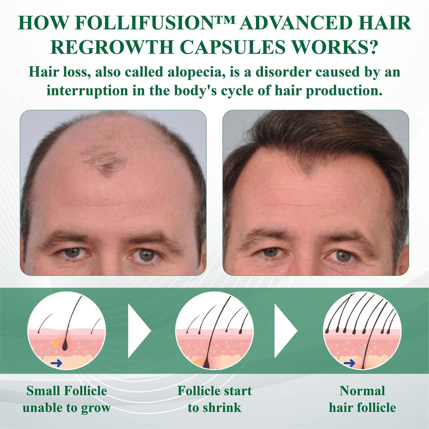 FolliFusion™ Advanced Hair Regrowth Capsules