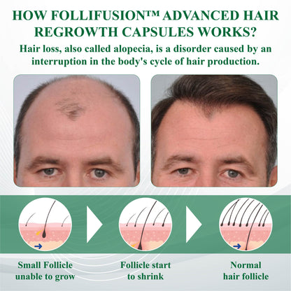 FolliFusion™ Advanced Hair Regrowth Capsules