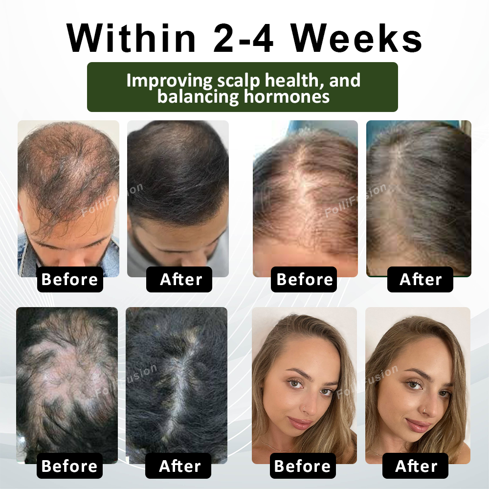 FolliFusion™ Advanced Hair Regrowth Capsules