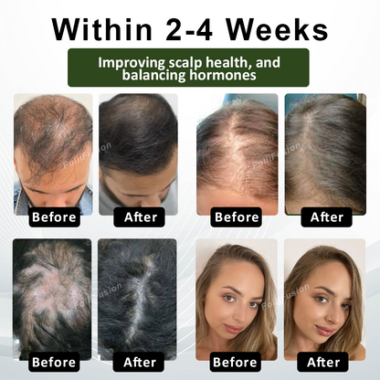 FolliFusion™ Advanced Hair Regrowth Capsules