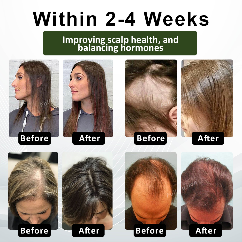FolliFusion™ Advanced Hair Regrowth Capsules