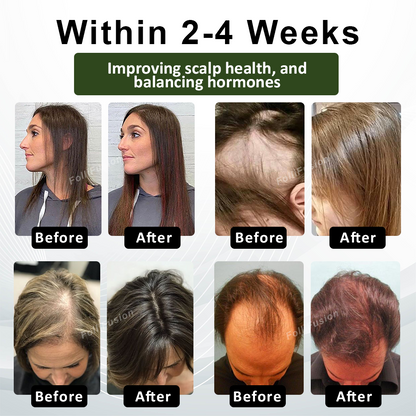 FolliFusion™ Advanced Hair Regrowth Capsules