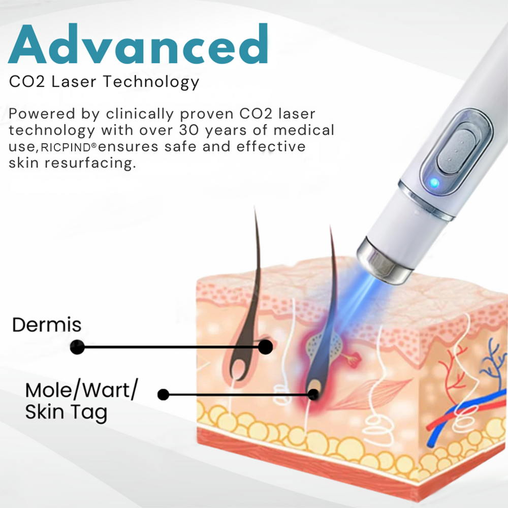 RICPIND® Non-Invasive Mole and Wart Removal Laser Pen