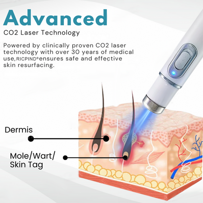 RICPIND® Non-Invasive Mole and Wart Removal Laser Pen